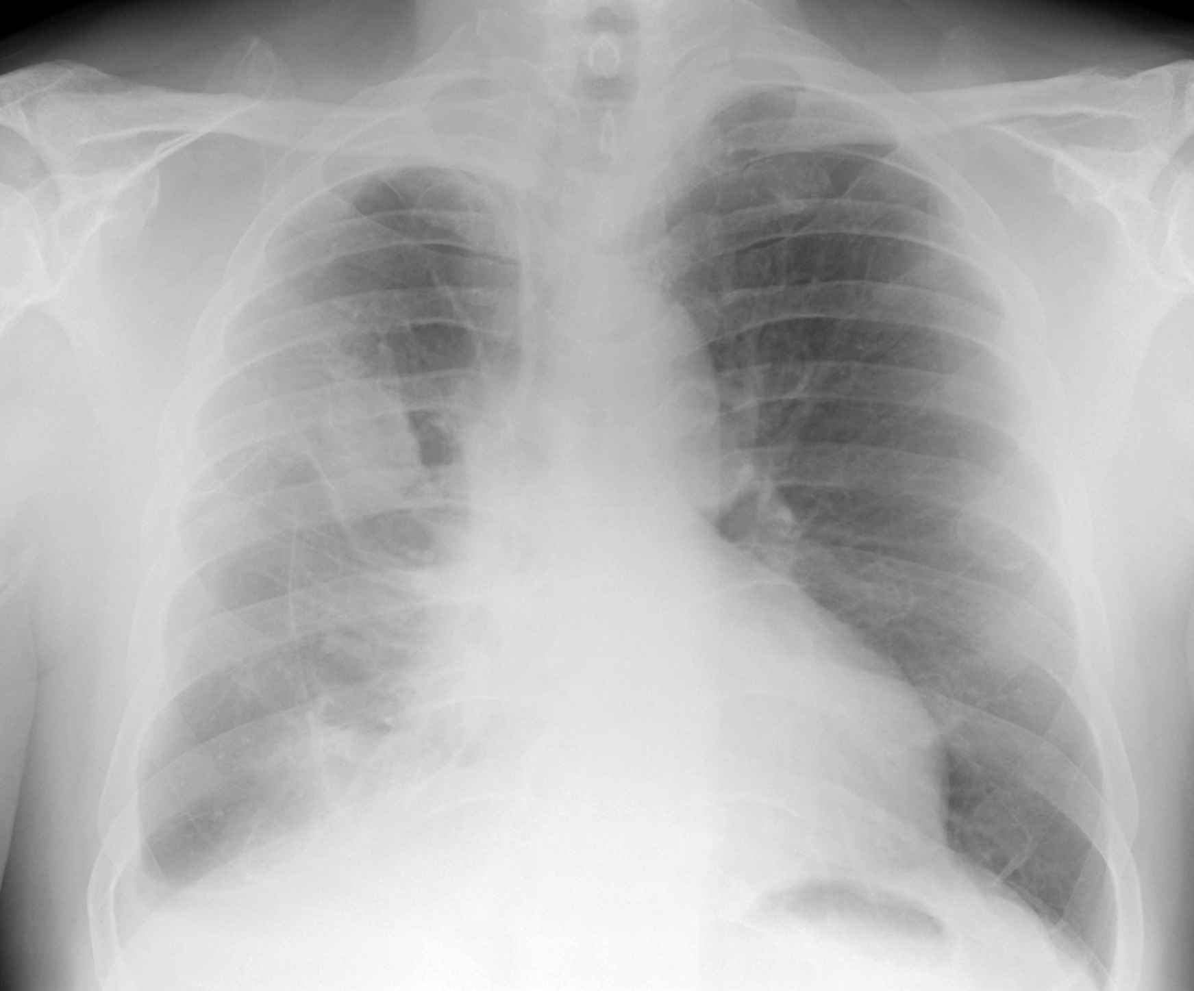 Global Incidence, Risk Factors, and Temporal Trends of Mesothelioma: A Population-Based Study