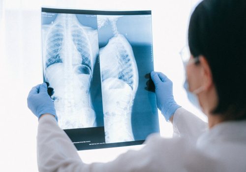 Distribution, Risk Factors, and Temporal Trends for Lung Cancer Incidence and Mortality A Global Analysis