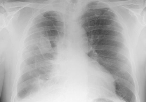 Global Incidence, Risk Factors, and Temporal Trends of Mesothelioma: A Population-Based Study
